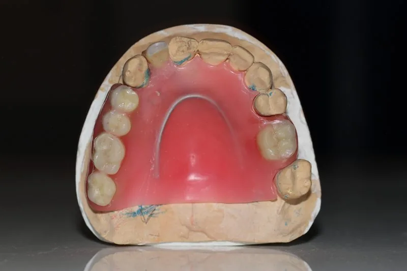 Partial denture teeth set in wax dental lab